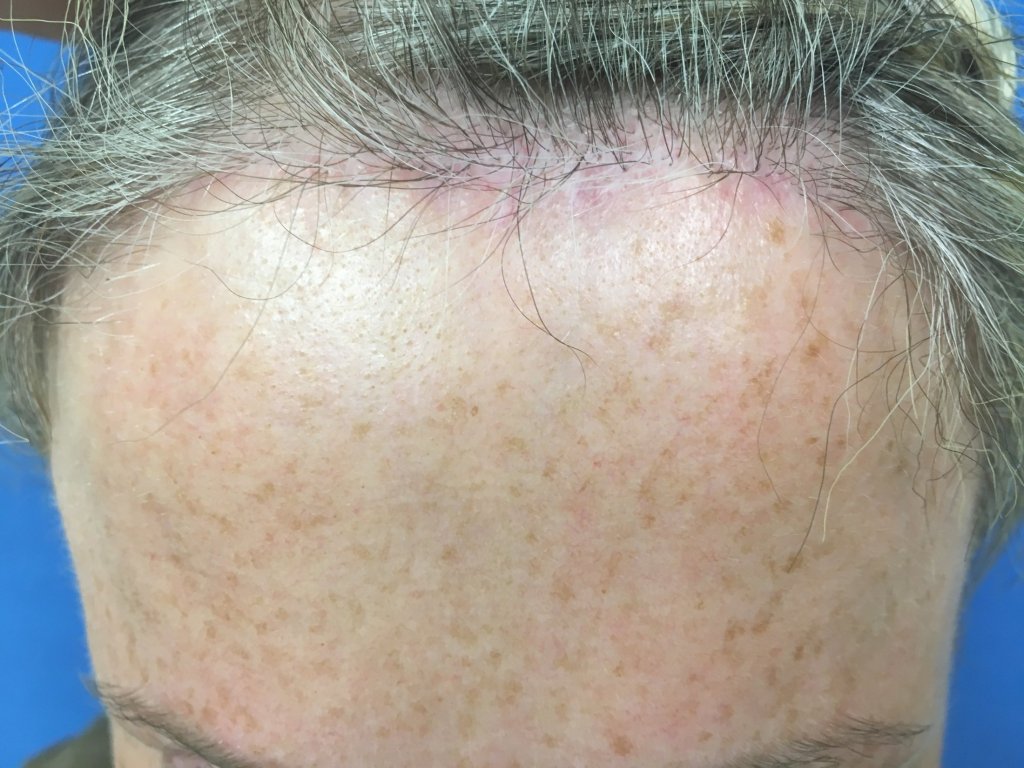 After a mini brow lift