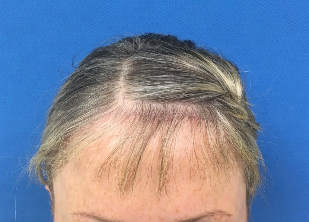 Before a mini brow lift