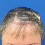 Before a mini brow lift
