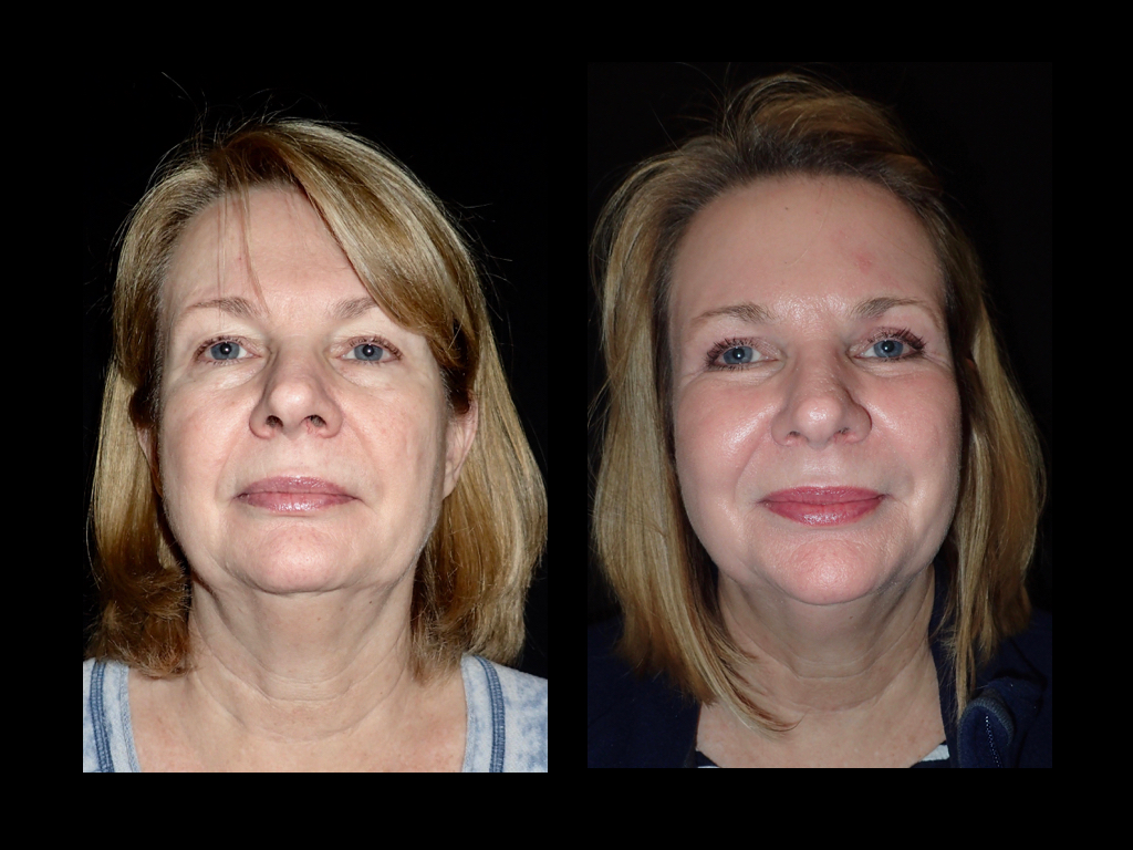 Front view of before and after laser skin resurfacing