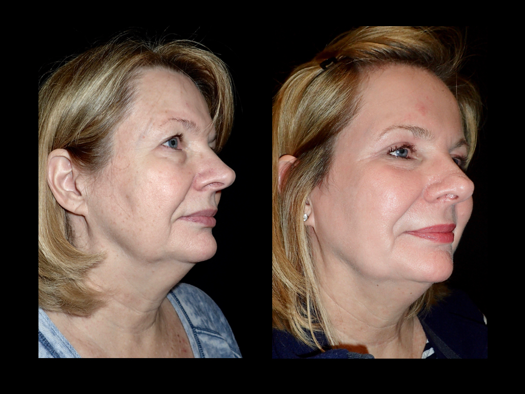 Before and after laser skin resurfacing