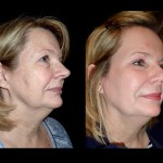 Before and after laser skin resurfacing