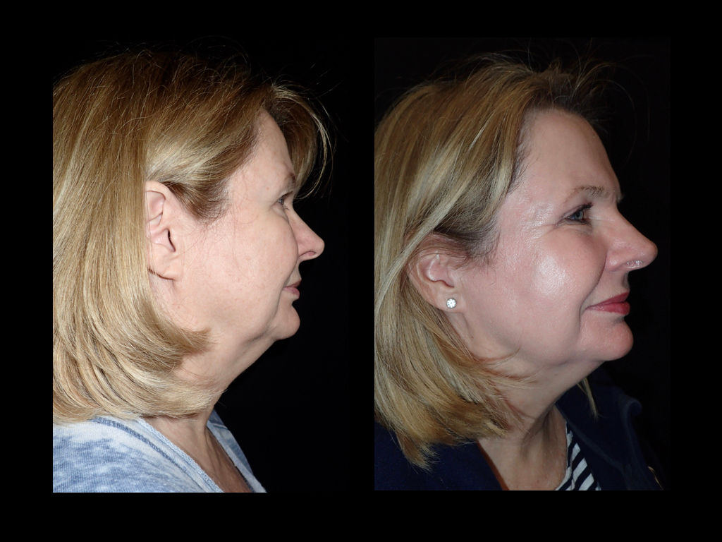 Side view of before and after laser skin resurfacing