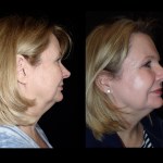 Side view of before and after laser skin resurfacing