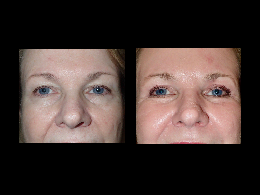 Front view of before and after laser skin resurfacing
