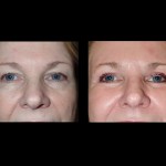 Front view of before and after laser skin resurfacing