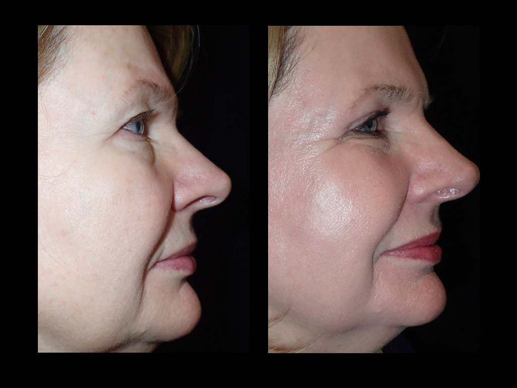 Side view of before and after laser skin resurfacing