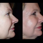 Side view of before and after laser skin resurfacing