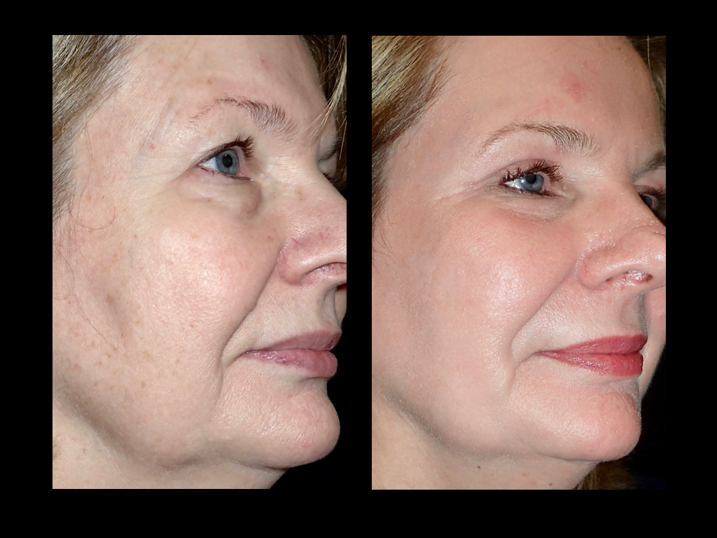 Before and after laser skin resurfacing