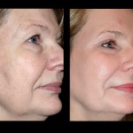 Before and after laser skin resurfacing