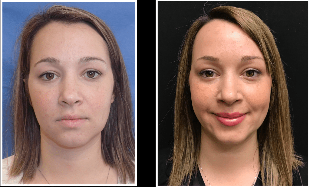 Before and after lip and volume restoration