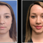 Before and after lip and volume restoration