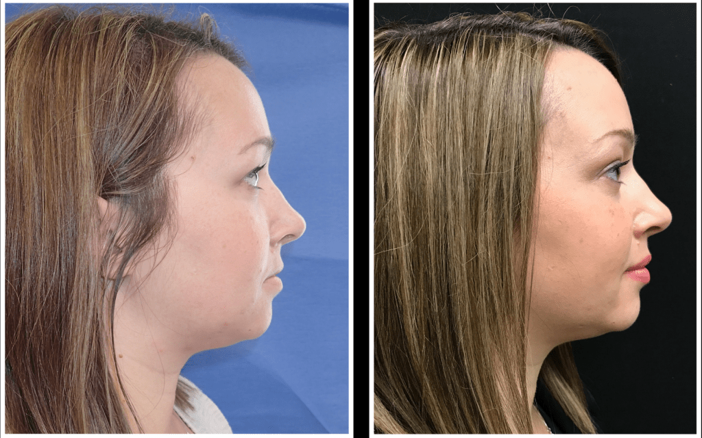 Before and after lip and volume restoration