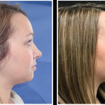 Before and after lip and volume restoration