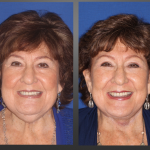 before and after Facelift surgery photos