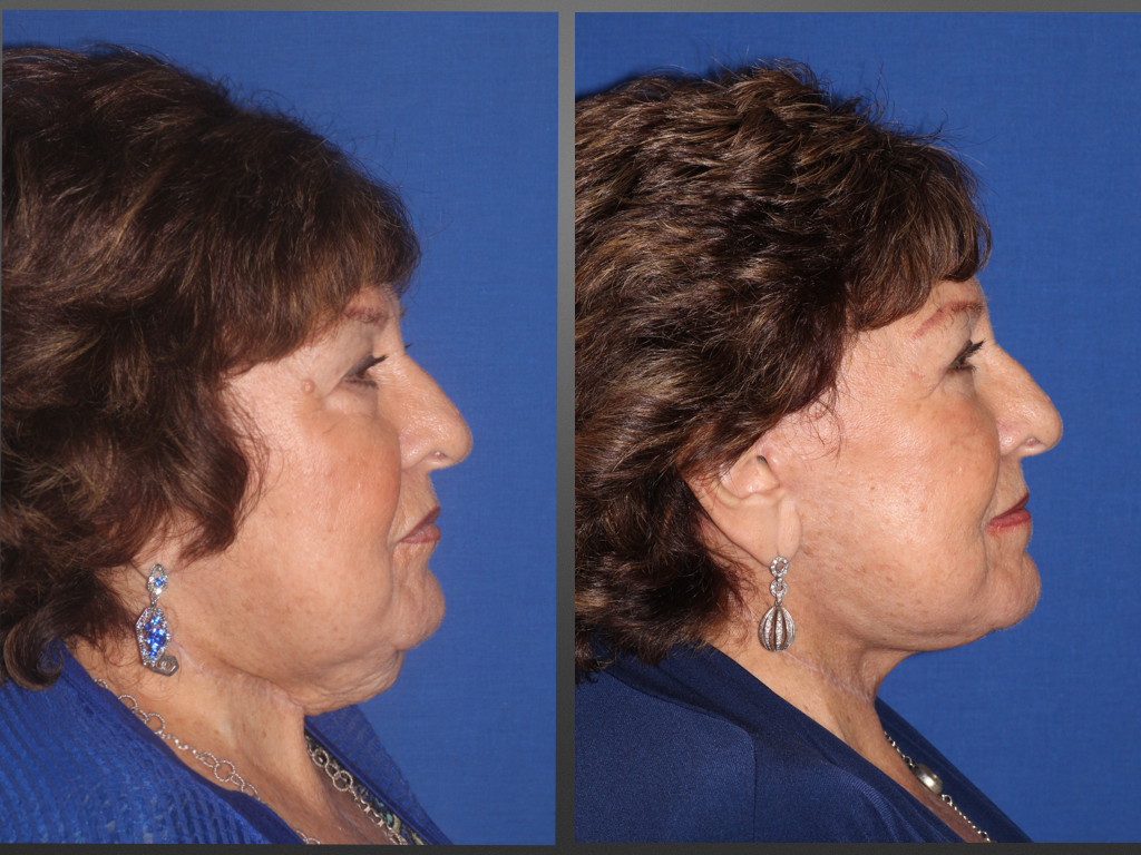 Side view of before and after a neck lift