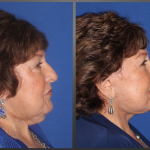 Side view of before and after a neck lift