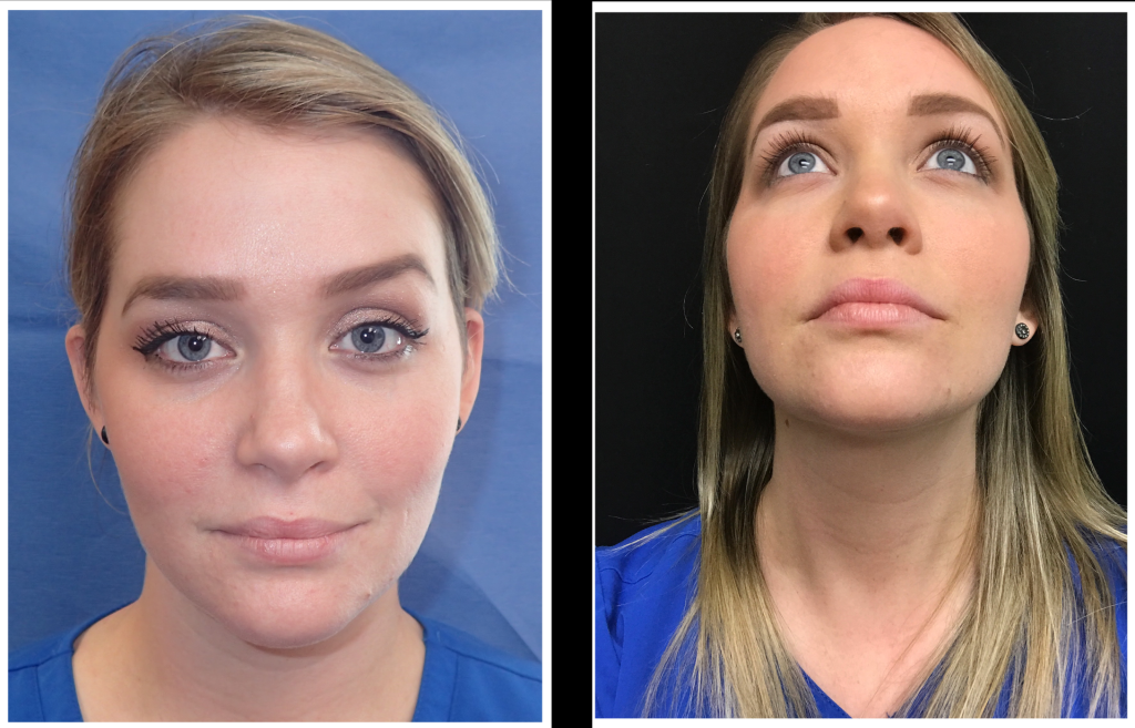 Before and after lip and volume restoration