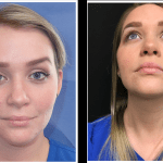 Before and after lip and volume restoration