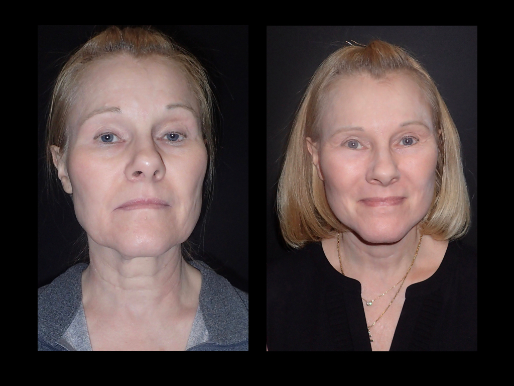 before and after Facelift surgery photos