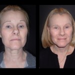 before and after Facelift surgery photos