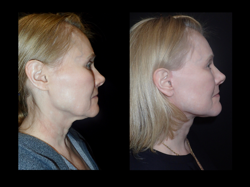 before and after Facelift surgery photos
