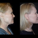 before and after Facelift surgery photos