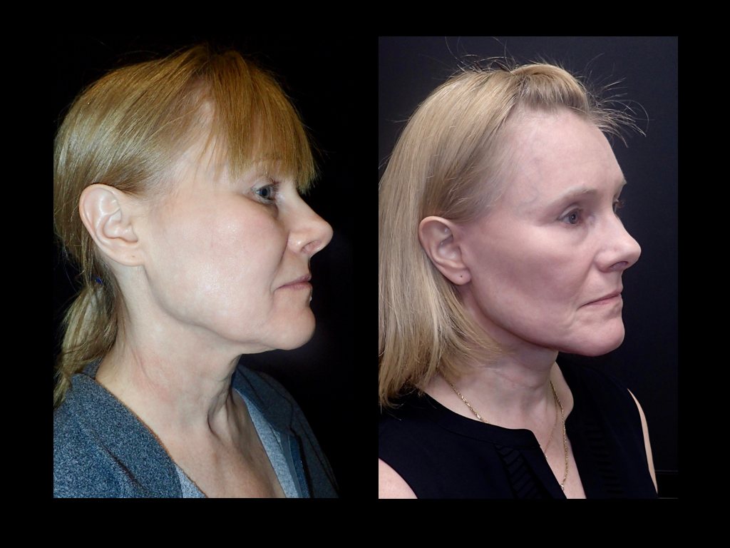 before and after Facelift surgery photos