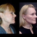 before and after Facelift surgery photos