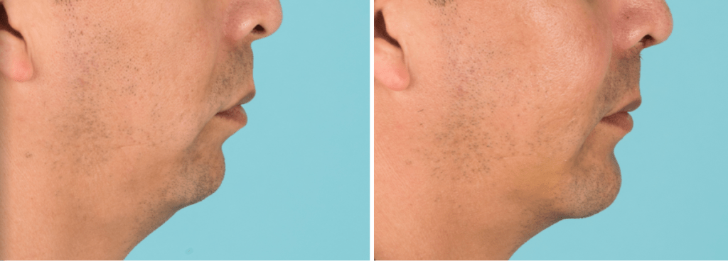 Before and after a chin implant