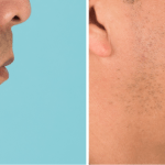 Before and after a chin implant