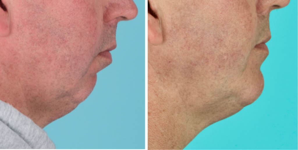 mens cosmetic surgery before and after photos