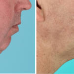 mens cosmetic surgery before and after photos