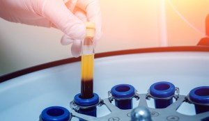 PRP Hair Restoration