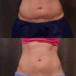 Facelift Before and After