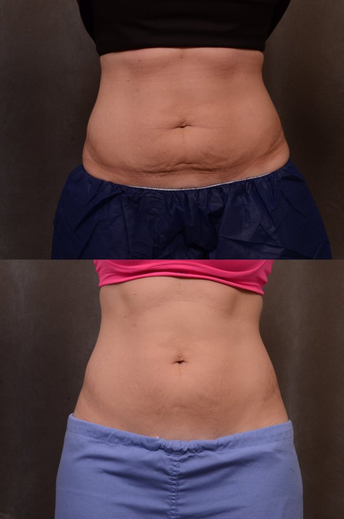 Facelift Before and After