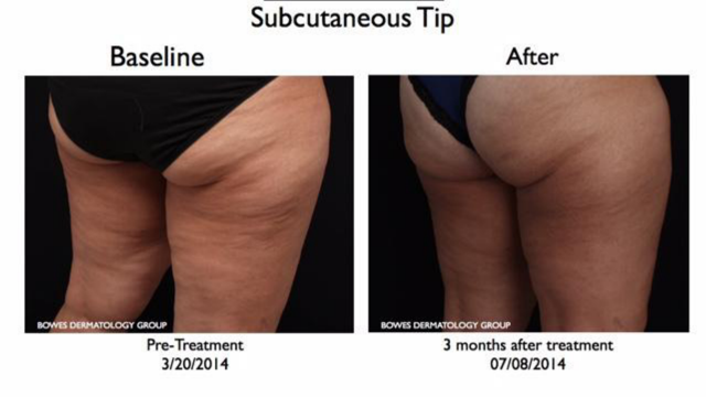 Facelift Before and After