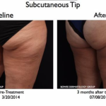 Facelift Before and After