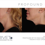 Facelift Before and After