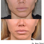 Facelift Before and After