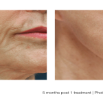 Facelift Before and After