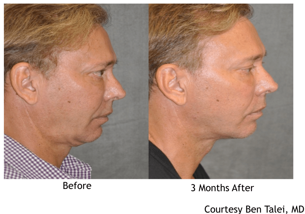 Facelift Before and After