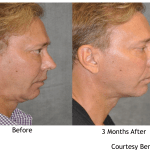 Facelift Before and After