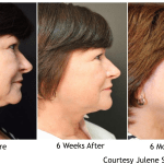 Facelift Before and After