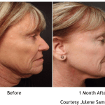 Facelift Before and After