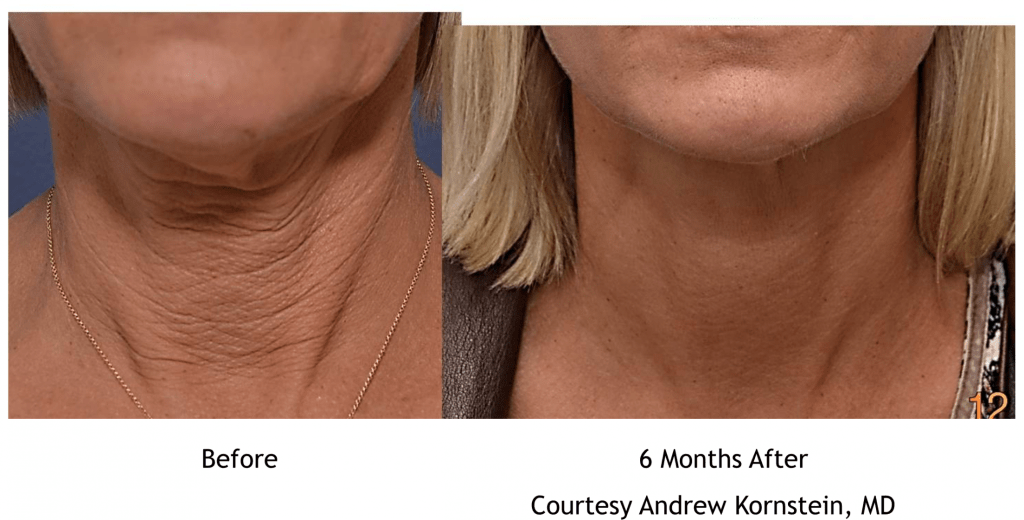 Facelift Before and After