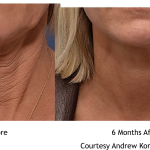 Facelift Before and After