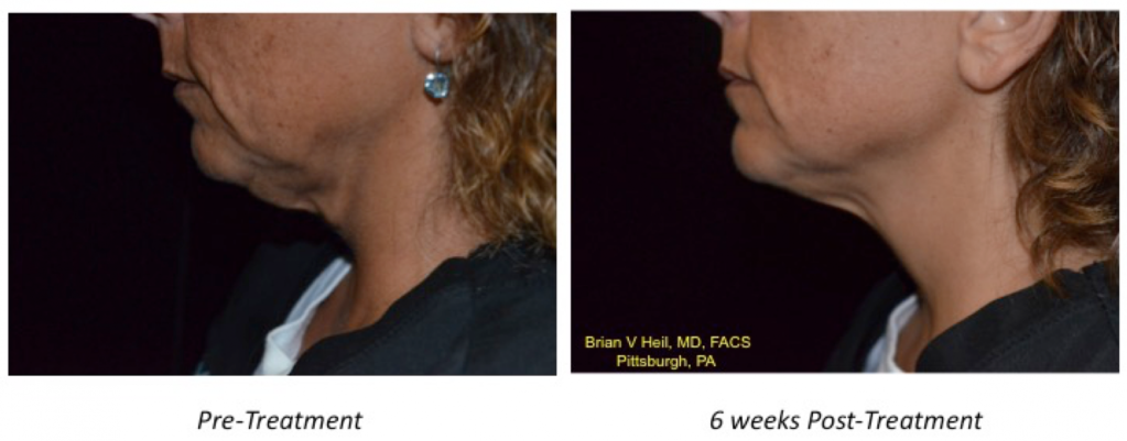 Facelift Before and After
