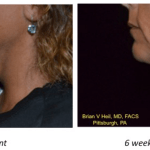 Facelift Before and After