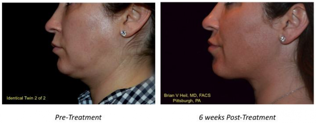 Facelift Before and After
